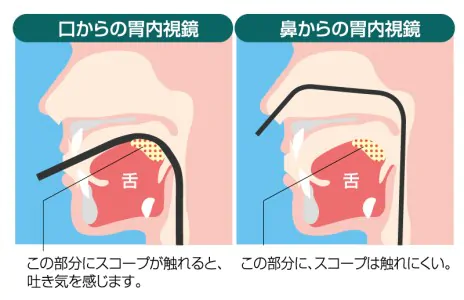 経鼻内視鏡と経口内視鏡を選択できる