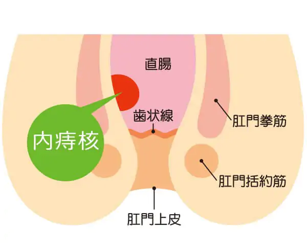 いぼ痔（痔核）について