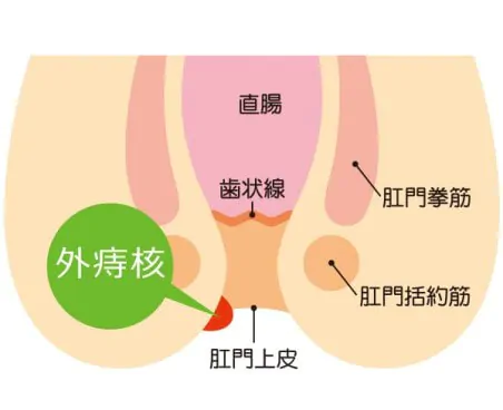 外痔核について