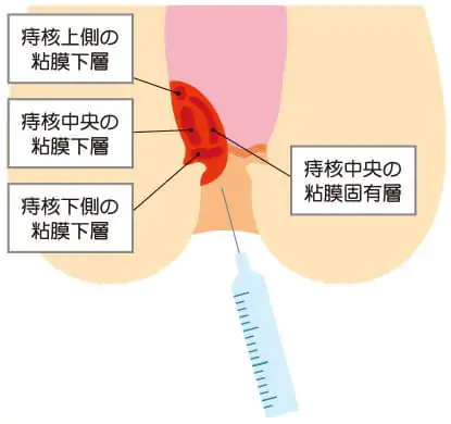 ジオン注射（ALTA療法）とは